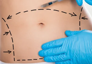 جراحی شکم یا ابدومینوپلاستی چیست؟