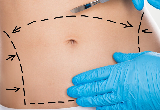 جراحی شکم یا ابدومینوپلاستی چیست؟