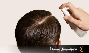 آشنایی با داروی ماینوکسیدیل minoxidil