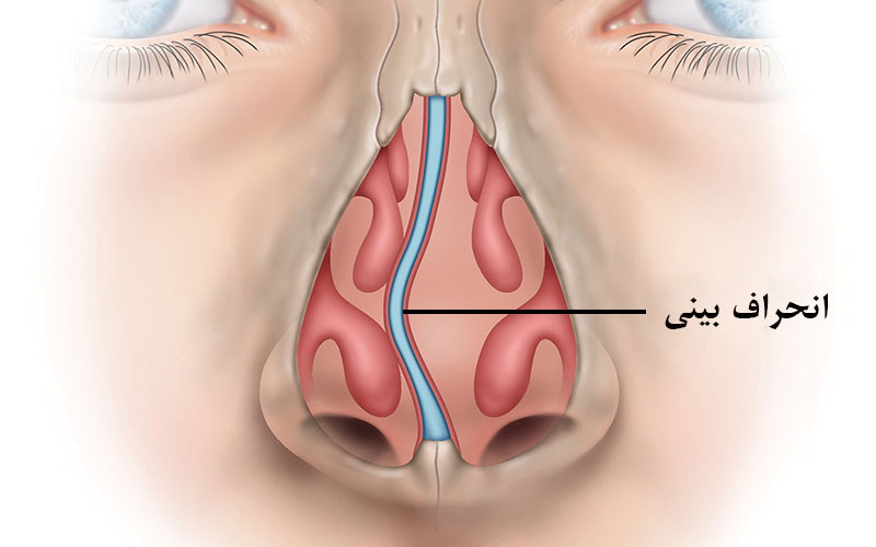 راه درمان انحراف بینی