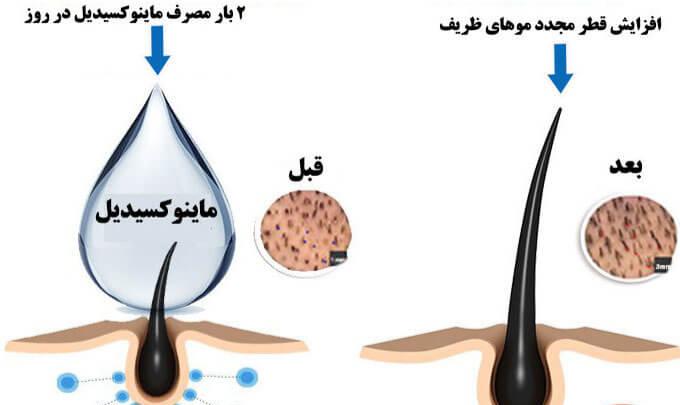 طریقه مصرف داروی ماینوکسیدیل