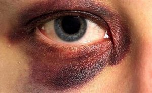 علت ورم و کبودی چشم بعد از کاشت ابرو چیست؟