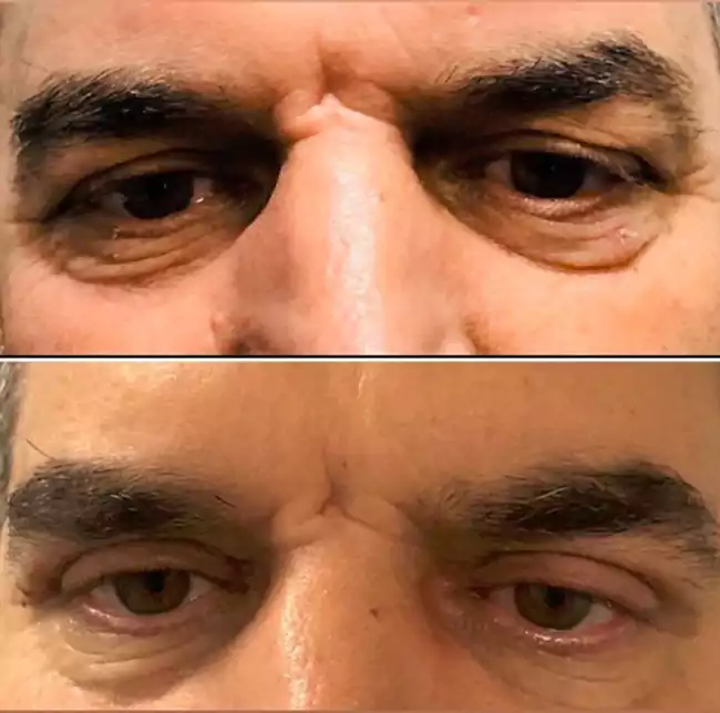 قبل و بعد از جراحی پلک یا بلفاروپلاستی